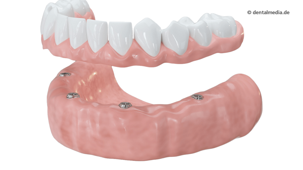 Ein Großteil der Zähne oder alle Zähne fehlen. Mit mehreren Implantaten haben Teil- oder Vollprothesen, herausnehmbar oder festsitzend, einen festen Halt.
