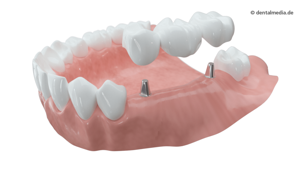 Mehrere Zähne fehlen: Die fehlenden Zähne werden durch Implantate ersetzt, auf die eine Brücke aufgesetzt wird. Nachbarzähne bleiben voll erhalten.